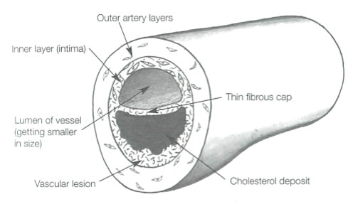 Vascular disease introduction graph 5
